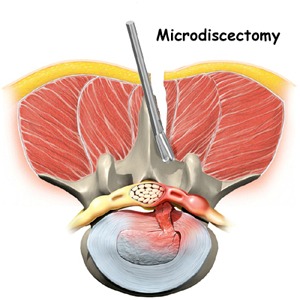 Microdiscectomy