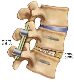 Spinal Fusion to Treat Lower Right Back Pain